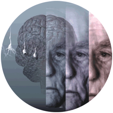 alzheimer Descubren la forma en que el Alzheimer afecta el cerebro