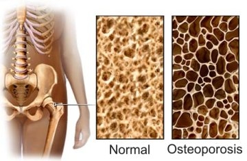 Descubierta una forma de frenar a las células “comedoras de hueso” en la osteoporosis
