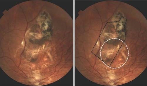 Prueba éxito implante de retina creado a partir de células madre y un polímero