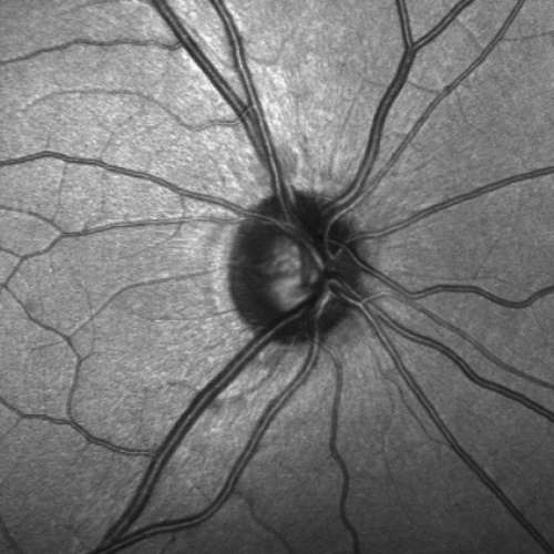 Hallazgo de células madre en el nervio óptico da luz para tratar el glaucoma