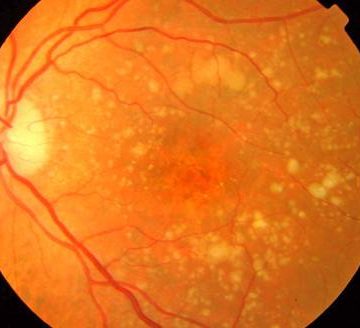 Un implante ocular restaura la visión central en pacientes con daños en la retina
