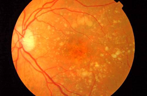 ojo Un implante ocular restaura la visión central en pacientes con daños en la retina